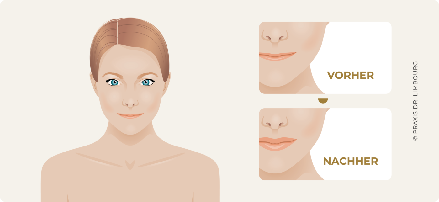 fehlendes Lippenvolumen