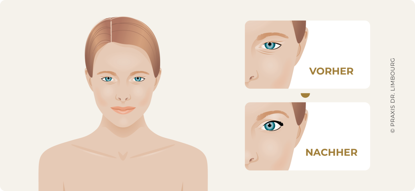 Ober- Unterlidfalten