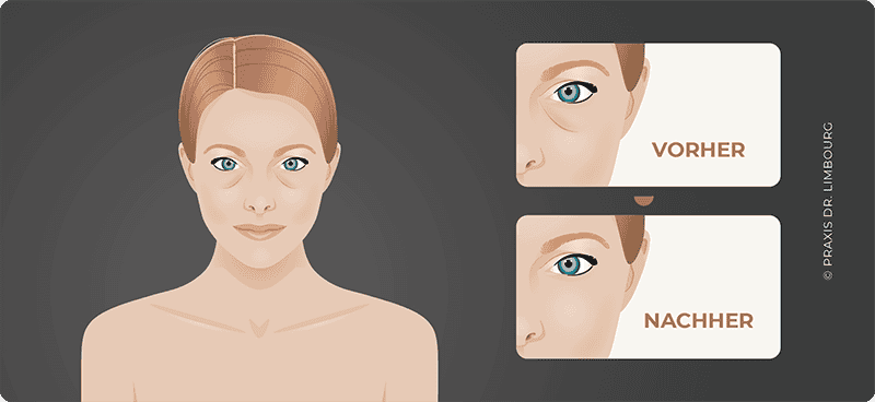 Faltenbehandlung um die Augenregion
