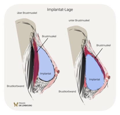 Lage Brustimplanat Brustvergrößerung